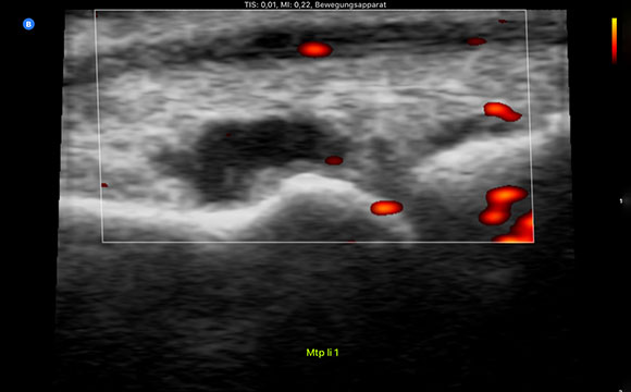 Gelenkerguss Ultraschall
