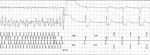 Defibrillatoren