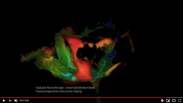 Videothumbnail Fluoreszenzgestütztes Aneurysma Clipping