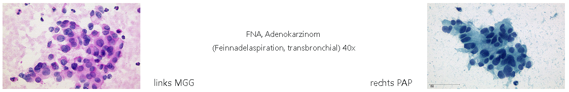 Fna Adenokarzinom Pathologie