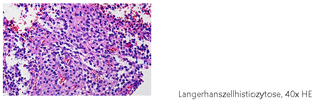 Langerhanszellhistiozytose Pathologie