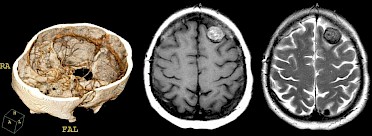 Ag Neuroradiologie