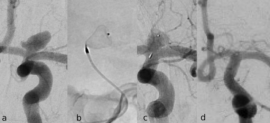 Aneurysma Arteria Carotis Interna