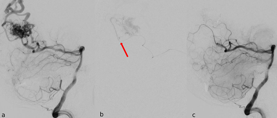 Arteriovenoese Malformation