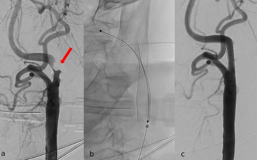 Hochgradige Stenose Arteria Carotis Interna