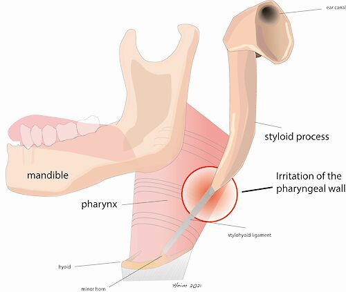 Nicht zuletzt wegen der vielen unterschiedlichen Symptome bleibt das Syndrom häufig eine Ausschlussdiagnose, wenn die häufigeren anderen Gründe für Beschwerden ausgeschlossen sind.