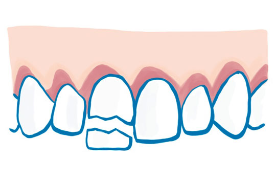 Grafik Abgebrochener Zahn
