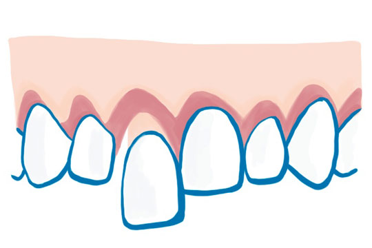 Grafik gelockerter Zahn