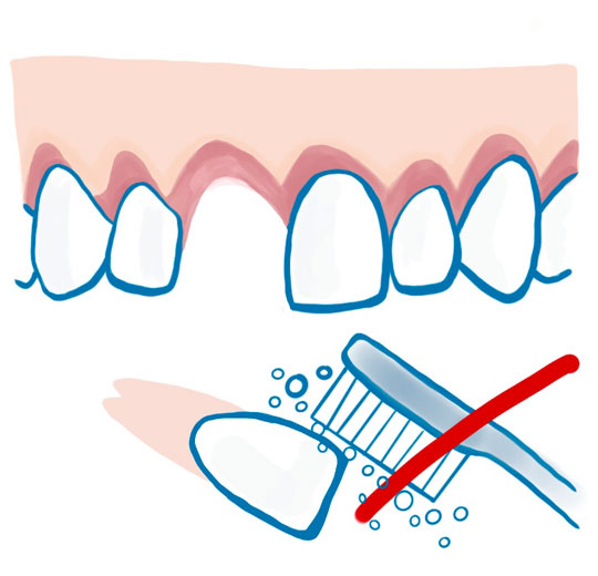 Grafik ausgeschlagener Zahn