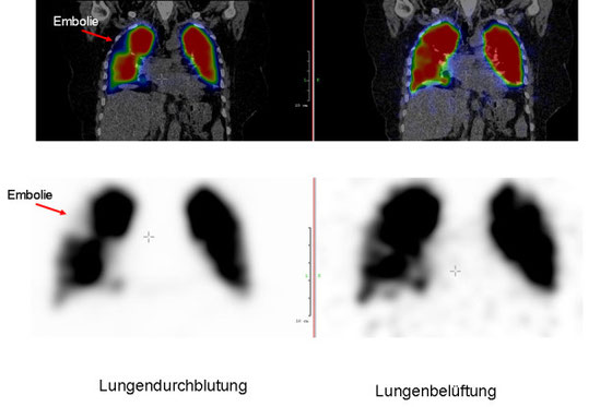 Aufnahme Lungenszintigrafie
