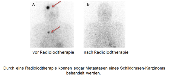 Radiojodtherapie