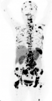 Knochen- und Lymphknotenmetastasen