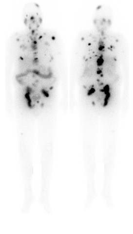 PET/CET Aufnahme von Metastasen nach Applikation des Lu-PSMA
