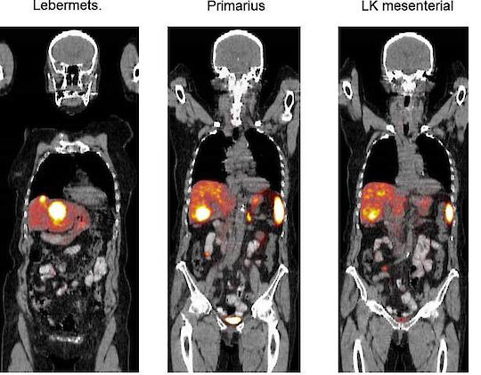 Aufnahme Lebermetastasen
