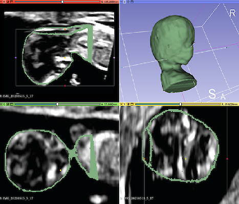 3D Rekonstruktion Fetus