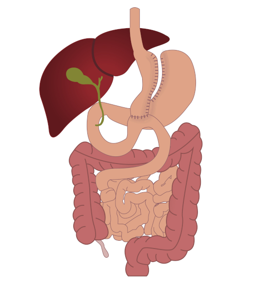 Omega-Loop, Adipositaszentrum BIOM