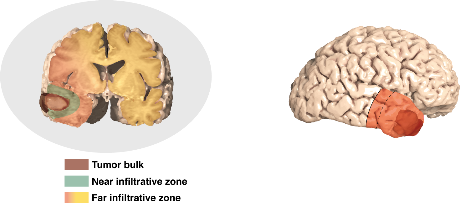 Connecting Tumor And Epilepsy Surgery