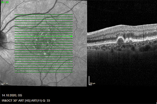 Augenheilkundliche Untersuchung mit KI