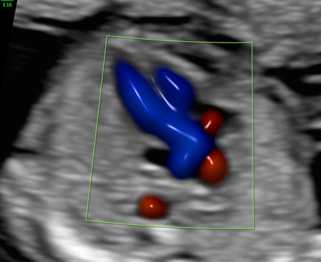 Ersttrimesterdiagnostik Nackentransparenzmessung