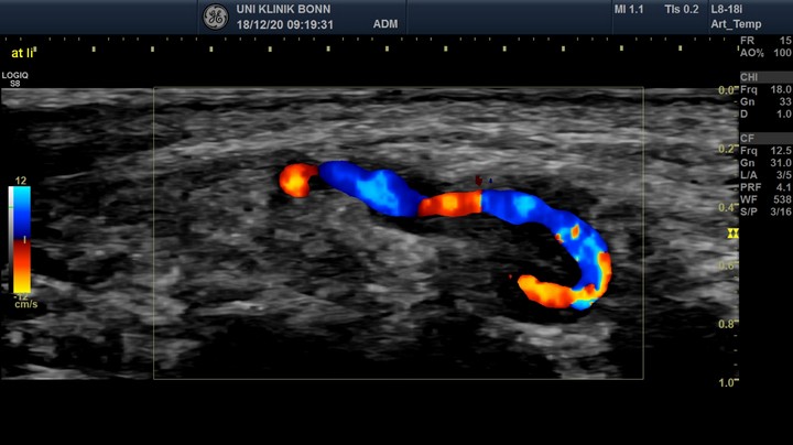 Ultraschall Riesenzellarteriitis