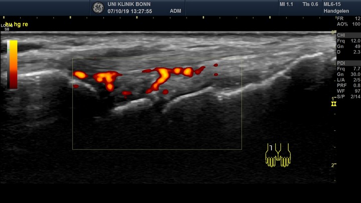 Gelenkultraschall Handgelenkarthritis