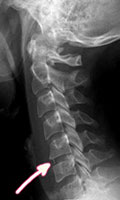 Röntgenaufnahme Halswirbelsäule Bandscheibenvorfall