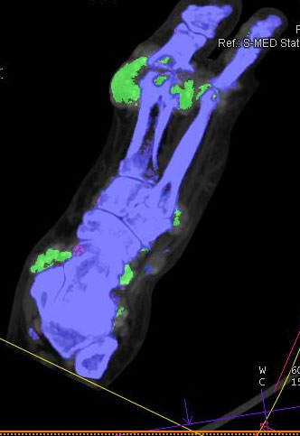 Gichtpatient Dual-Energy-CT