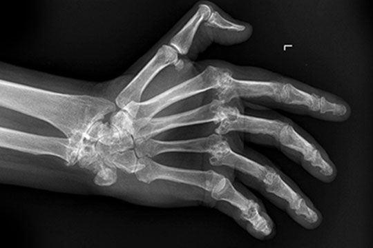 Röntgenbild einer Patientin mit rheumatoider Arthritis