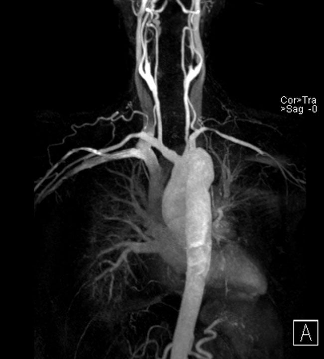 Magnetresonanz-Angiographie einer Patientin mir einer Takayasu Arteriits